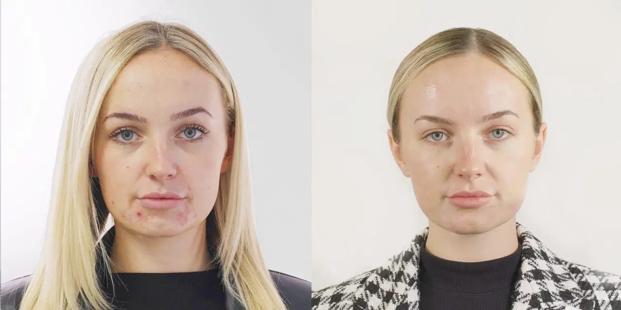 Seventy Hyal 2000 before & after full face