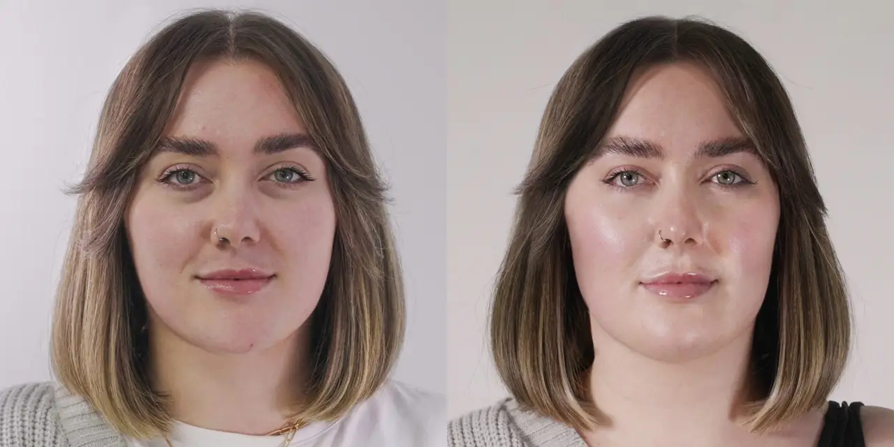 Seventy Hyal 2000 before & after under eyes